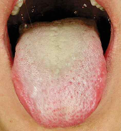 痰湿体质如何调理 痰湿体质舌像1.jpg