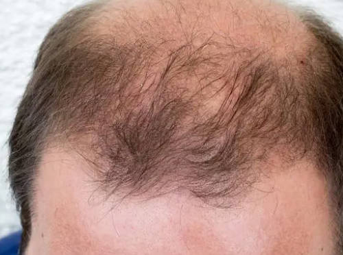 男性毛发与肾功能有密切关系